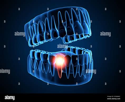 3d Render Of Jaw X Ray With Aching Premolar Tooth Toothache Concept