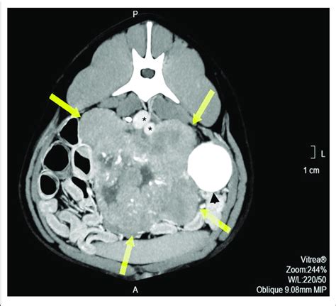 Pre Operative Contrast Enhanced Computed Tomography Axial Image
