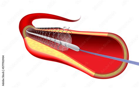 Medical And Educational Illustration Of Stent Implantation To Support