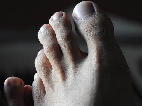 Symptoms Of Toe Arthritis