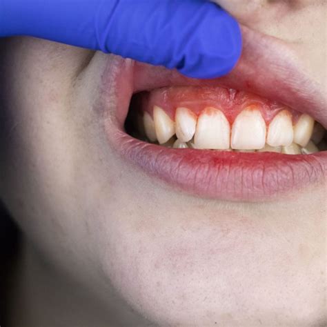Gum Disease Causes Types Symptoms Dr Pascal Terjanian