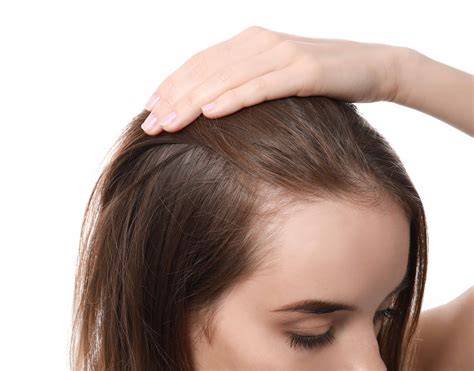 Kreisrunder Haarausfall Bei Frauen Ursachen Behandlung Bella Bellice