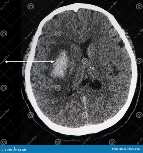 Intracerebral Hemorrhage CT Scan Of Brain Stock Photo Image Of