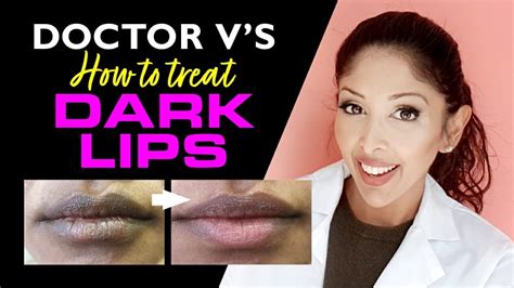Doctor V How To Treat Lip Hyperpigmentation Dark Lips Brown Dark