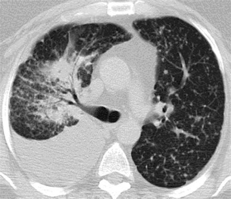 A Case Report Of Egfr Mutated Metastatic Lung