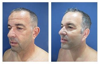 Coldiron and the skin cancer center:dr. How Much Does a Facelift Cost | Dr. Mowlavi | Cosmetic ...