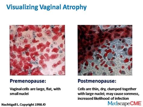 Addressing Vaginal Atrophy With Your Patients Modifying An Existing