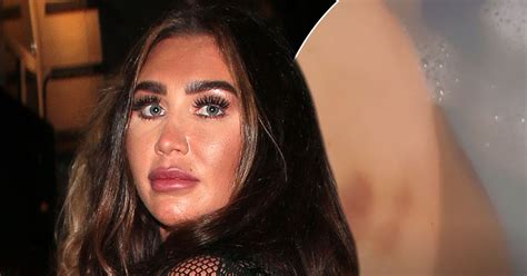 Lauren Goodger Reveals Bruises In The Bath And Cancels New Years Eve