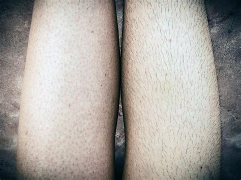 Razor burn and ingrown hairs are unsightly side effects of shaving, but they typically require a simple treatment and disappear after a few days. 15 Top Pictures Black Dots On Legs Ingrown Hairs - Ingrown ...