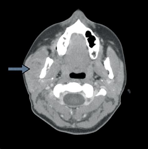 Ewings Sarcoma Of The Masseter Muscle The Journal Of Laryngology