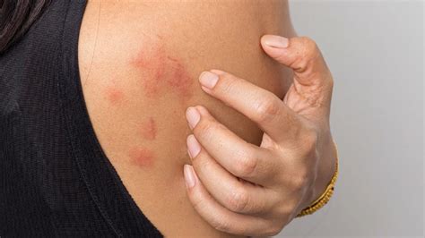 Stress Rash Spotting And Treating It Photo Examples