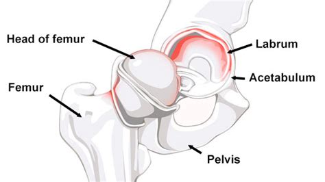 Labral Tear Of The Hip Joint An T M