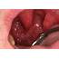Papilloma On The Uvula Squamous Of