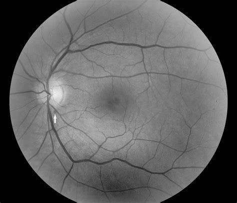 Visual Loss Retinal Hemorrhages And Optic Disc Edema Resulting From