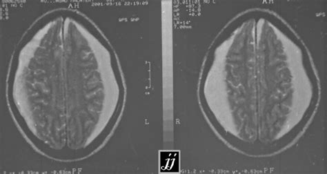 Hematoma Subdural Hematoma 27 Radioogle