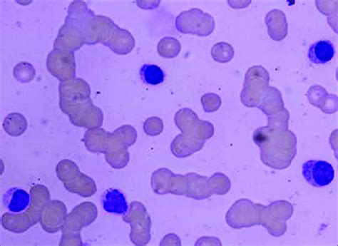 Peripheral Smear Showing Background Staining Rouleaux Formation And