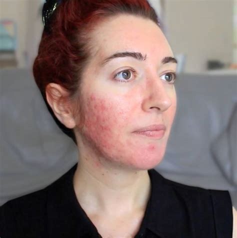 Woman Who Suffered Severe Acne For 15 Years On How She Finally Cleared