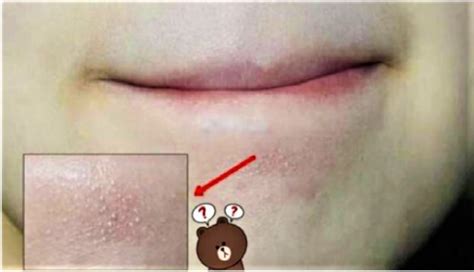 Apakah akta di bawah tangan tetap sah secara hukum? Tahukah Kenapa Ada Bintik-bintik Kecil Di Bawah Mulut Atau ...