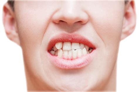 Crooked Teeth Causes Impact And Treatment
