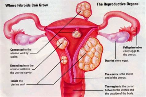 Fibroids And Infertility Nordica Fertility Centre