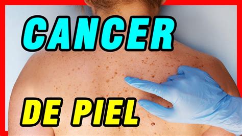 Cancer De Piel Como Reconocer Los Sintomas Del Cancer De Piel