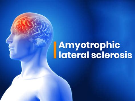 Amyotrophic Lateral Sclerosis Causes Symptoms Diagnosis And