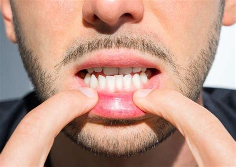 Can Braces Fix An Underbite Scaffidi Orthodontics