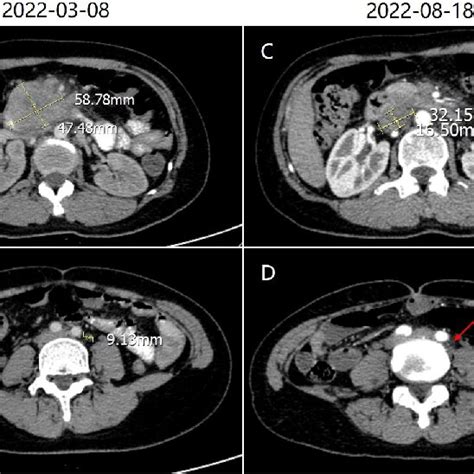 A Abdominal Contrast Enhanced Computed Tomography Ct Showed A Mass