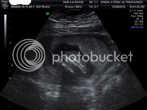 Anterior Placenta Babycenter