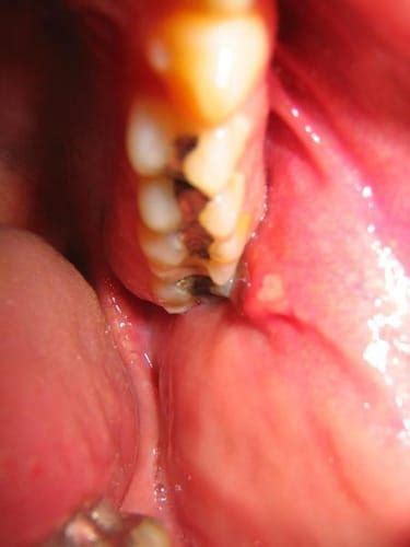 Sialadenitis Salivary Gland Infection Causes Symptoms And Treatment