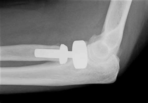 Radial Head Arthroplasty Using A Smooth Loosely Fit Stem Download