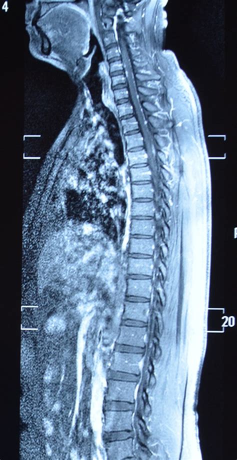 Sagittal Cervical Thoracic And Lumbar Mri Of The Spine Revealing