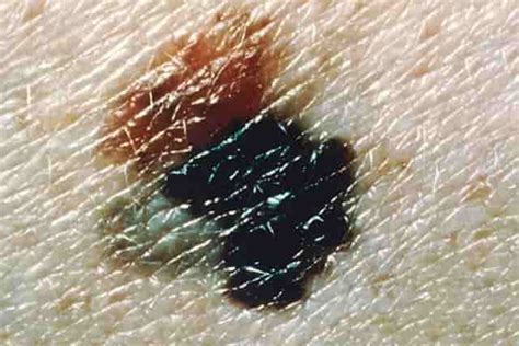 Black Spots On Skin Bellevue Laser And Cosmetic Center Lumps And