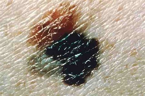 Do you think it sounds like something to be concerned about? Black Spots on Skin, Dots, Patches, Dark, Tiny, Itchy ...