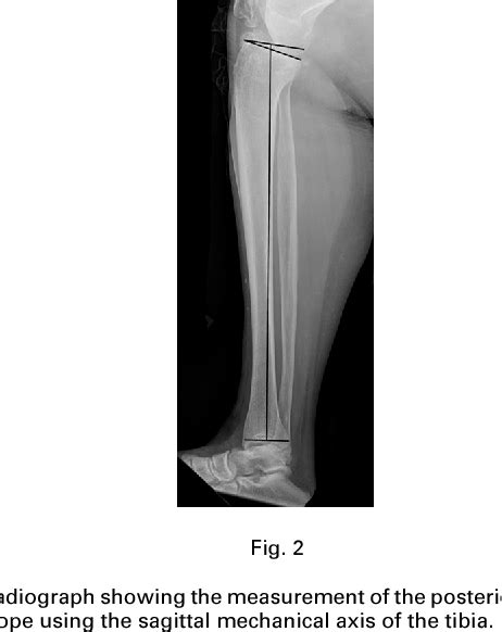 Figure 2 From Restoring The Anatomical Tibial Slope And Limb Axis May