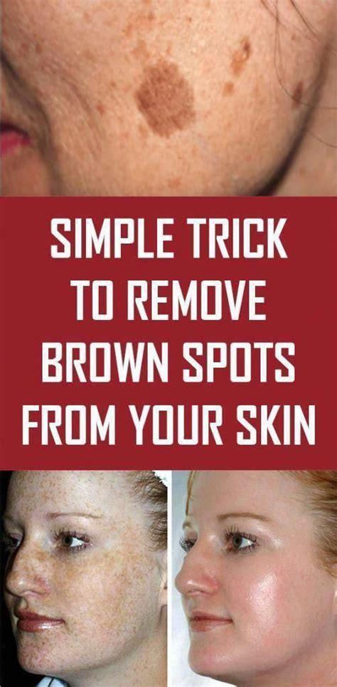 How To Get Rid Of Black Spots On Face