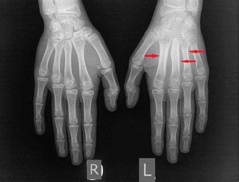 Plain Radiographs Of Both Hands Showing Cortical Thickening Of Ii Iii