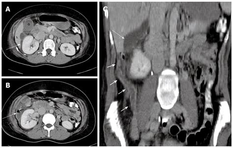 Ascending Retrocecal Appendicitis Presenting With Right Upper Abdominal
