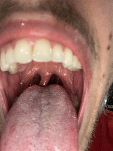 Large Bumps On Back Of Tongue 30m Usa Askdocs