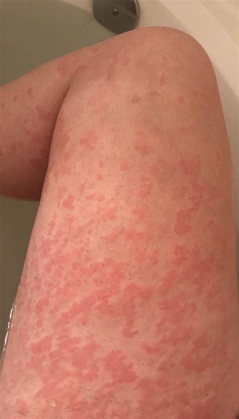 Hives From Stress More Info In Comments Urticaria