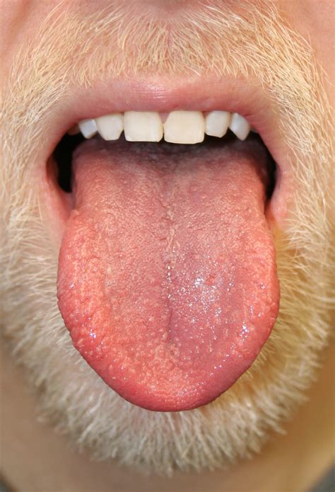 Sore White Bumps On Tongue