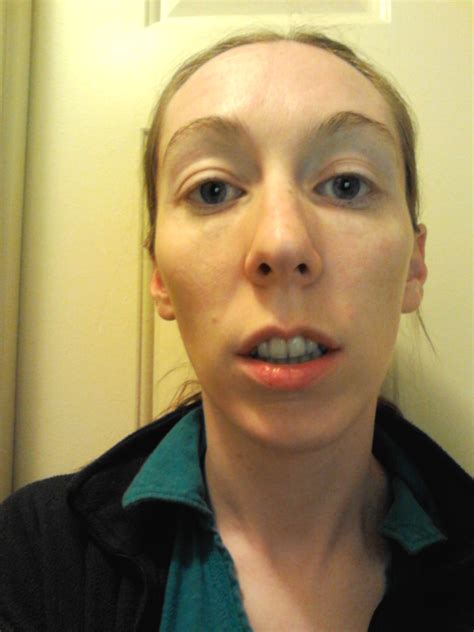 Let's send elongate to the moon and mars! Becky's Upper Jaw Surgery Blog
