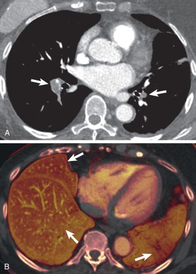 Acute Pulmonary Embolism Radiology Key