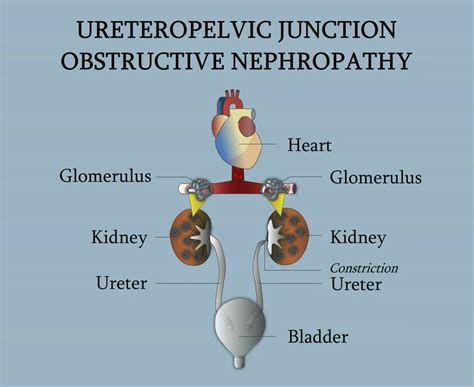 Ureteropelvic Junction Obstructive Nephropathy Youtube