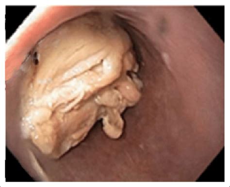 A glucagon nasal spray has recently been approved by the fda for hypoglycaemia rescue glucagon is not recommended for treatment of impacted esophageal food boluses due to significant side effects and poor effectiveness Impacted food bolus (chicken) in the lower esophagus at 35 ...