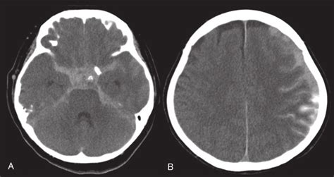 Post Operative Ct Shows Diffuse Subarachnoid Hemorrhage A And Left