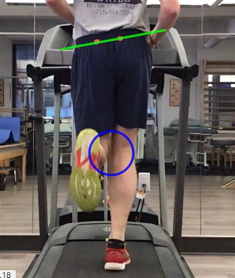 Running Analysis — Brill Physical Therapy