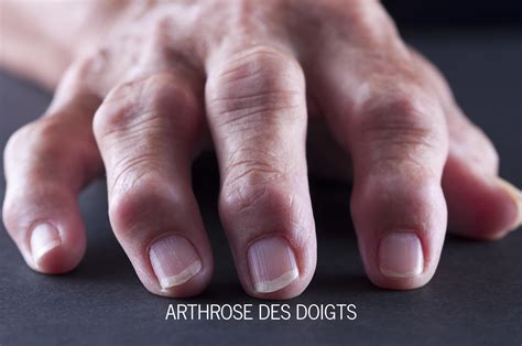 Arthrose Des Doigts Docteur Duché Avignon