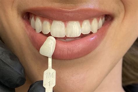 Zoom Teeth Whitening In Katy Tx Restore Your Smile