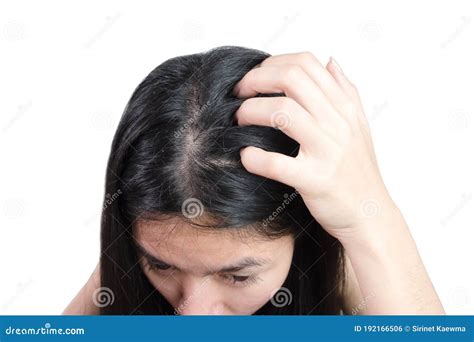 Women Head With Dandruff Caused By The Problem Of Dirty Or Caused By